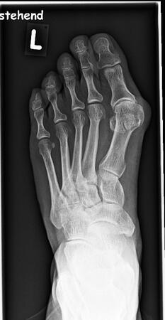 Hallux Valgus - Auf dem Röntgenbild ist die Deformierung der Großzehe deutlich zu sehen.